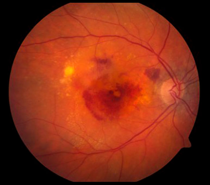 Macular Degeneration