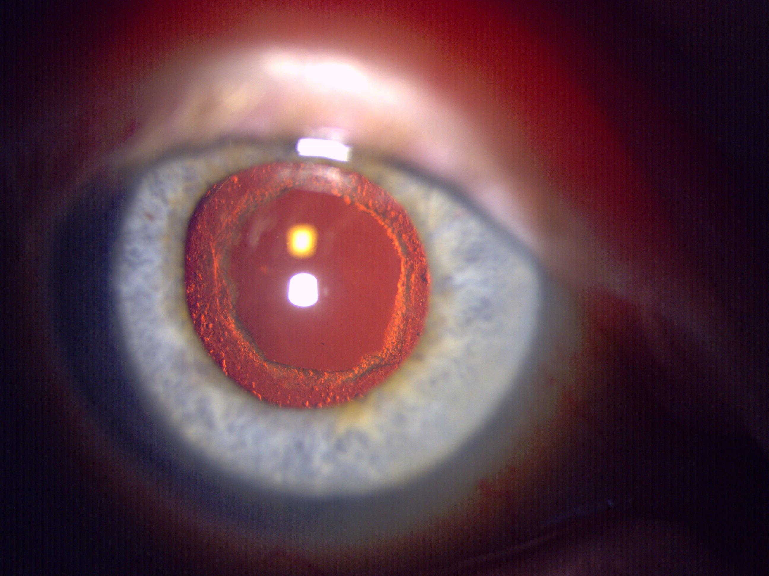 Secondary Cataract