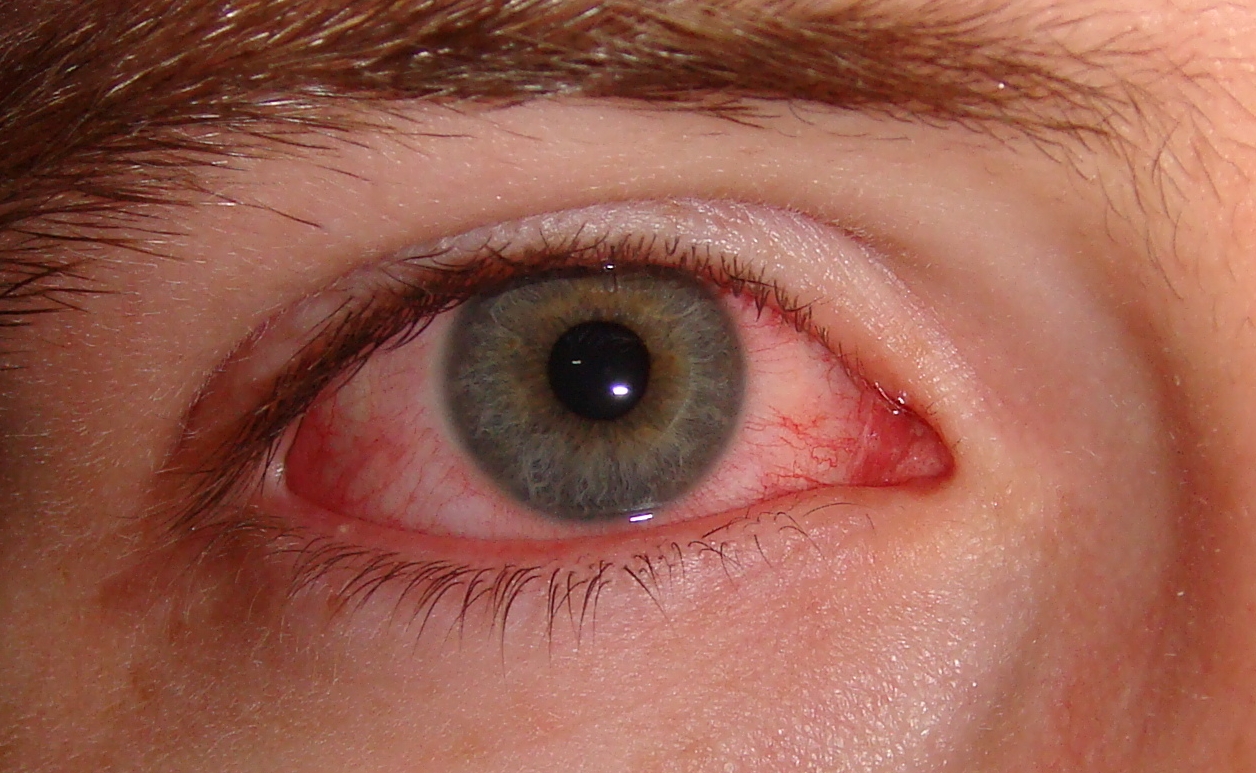 Red Eye and Allergy
